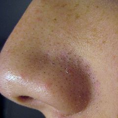 Blackheads and laser hair removal