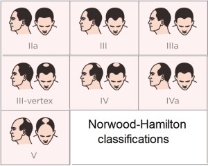 Norwood-Hamilton classifications scale of hair loss in MEN laser hair growth helmet