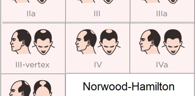 Norwood-Hamilton classifications scale of hair loss in MEN Capillus laser hair growth helmet