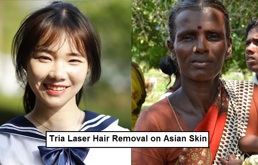 Laser Hair Removal Asian Skin 75
