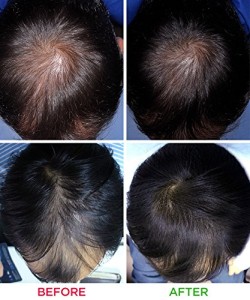 iRestore Laser Hair Growth System Before after